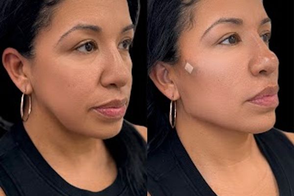 Med Spa NYC: Beso Aesthetics in New York, NY