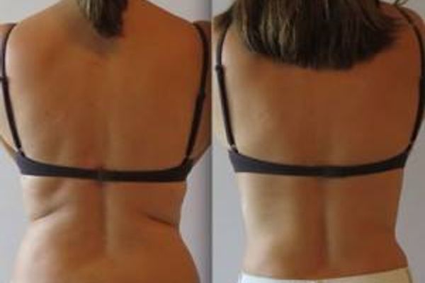 Weight Loss in Des Moines in Clive, IA